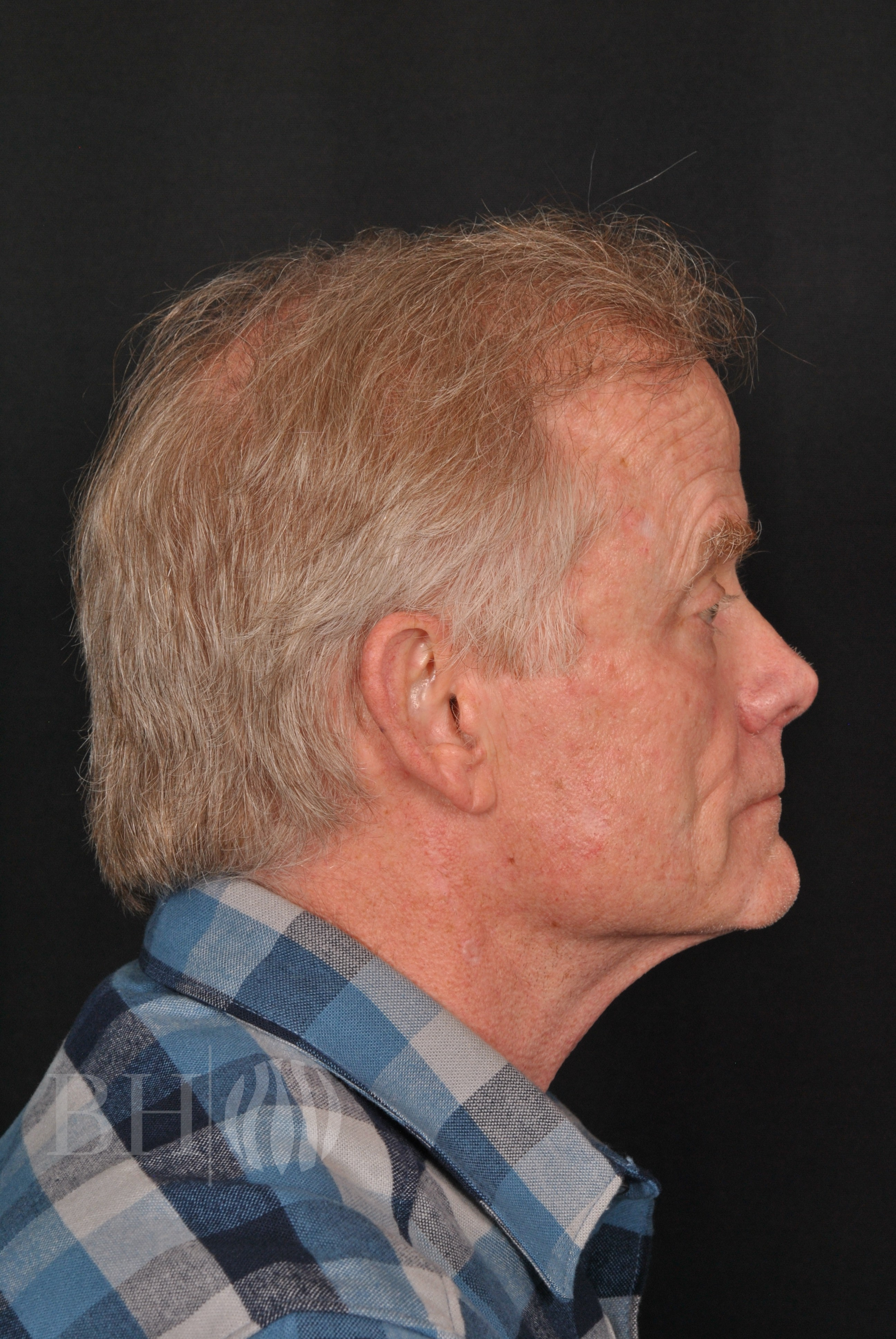 Neograft hair Before and After